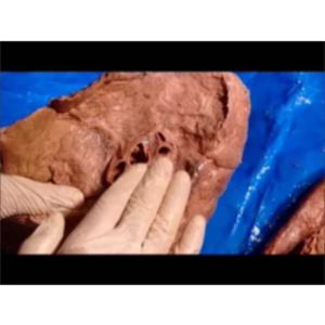 Right Pulmonary Surgical Anatomy - Sanjoy Sanyal icon