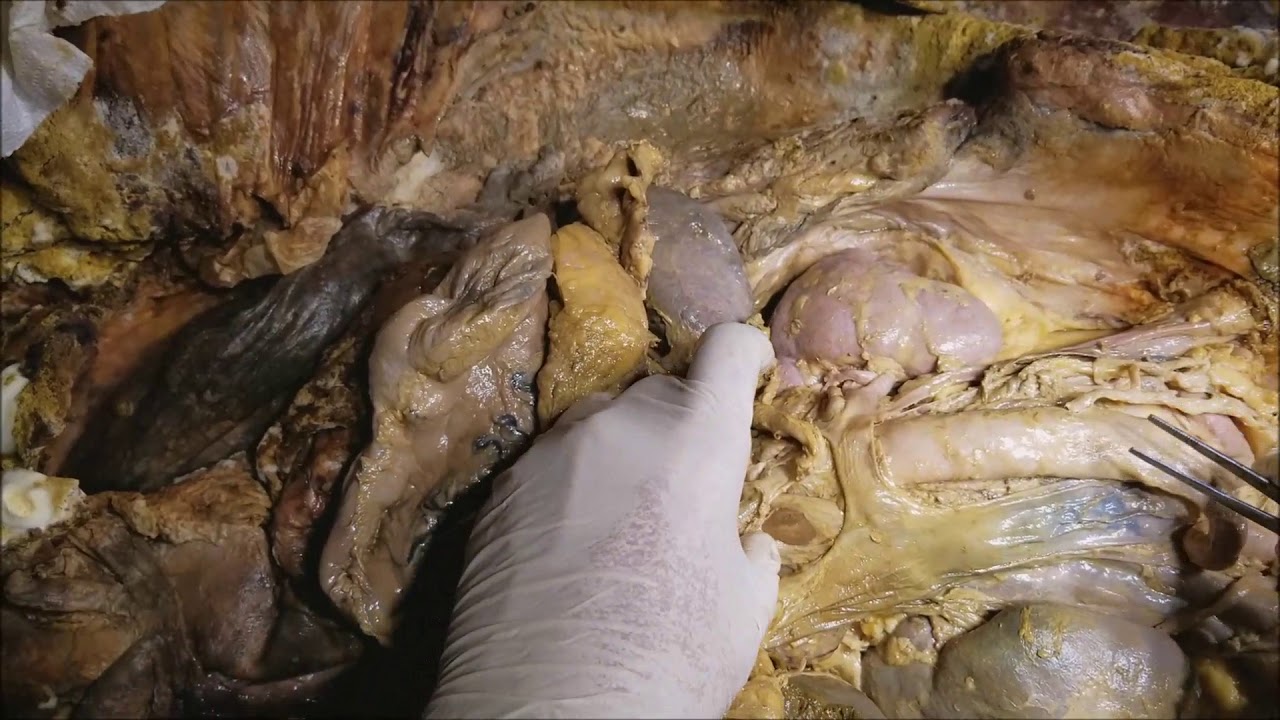 Abdominal Aorto-Caval Narrative Dissection with Surgical Correlations - Sanjoy Sanyal icon