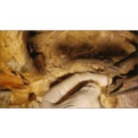 Subclavian Vessels-Brachial Plexus-Scalene Triangle Syndrome Demonstration - Sanjoy Sanyal icon