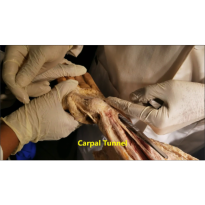 Neurovascular Distribution on Flexor Forearm and Pronator Syndrome-Sanjoy Sanyal icon