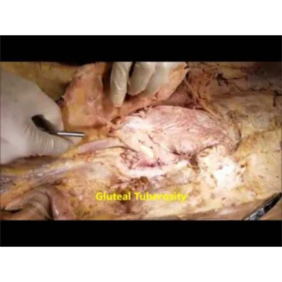 Superficial Glute Muscles Dissection And Trendelenburg Sign-Sanjoy Sanyal