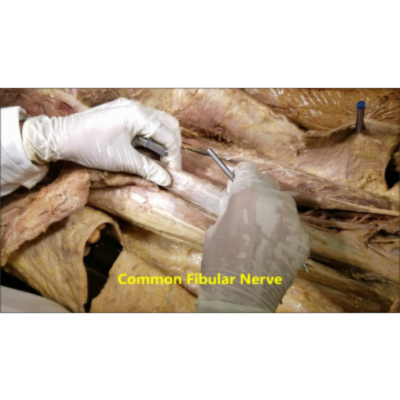 Thigh Hamstring Compartment Muscles Dissection-Popliteal Artery Entrapment - Sanjoy Sanyal