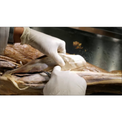 What is Triceps of Leg-Achilles Z-plasty-Freshman's Nerve - Sanjoy Sanyal icon