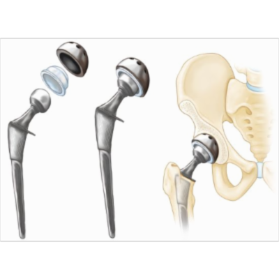 Total Hip Replacement - OrthoInfo - AAOS icon