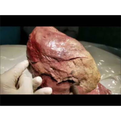 Topography and Clinical Aspects of Eviscerated Right Lung - Sanjoy Sanyal icon