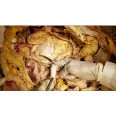 Inferior Mesenteric Hindgut Distribution - High Definition Clinical Demonstration – Sanjoy Sanyal icon