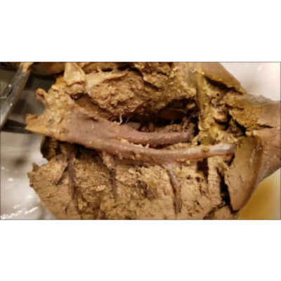Internal Architecture of Eviscerated Liver – Hepatic Veins Fissures Surgical Segments–Sanjoy Sanyal icon