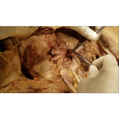 Ischioanal Fossa–Alcocks Canal–Sciatic Foramen–Pudendal Dissection-Clinical Narration–Sanjoy Sanyal icon