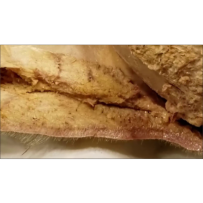 Scalp Dissected From Surgical Perspective–Danger Layer–Raccoon Eyes–Native Scalping–Sanjoy Sanyal