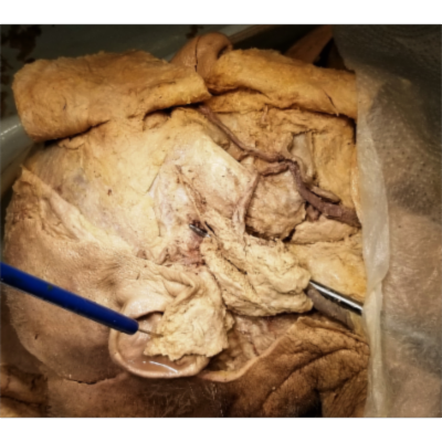 Parotid Gland and Stensen Duct Dissection – Exhaustive ClinicoAnatomical Review – Sanjoy Sanyal