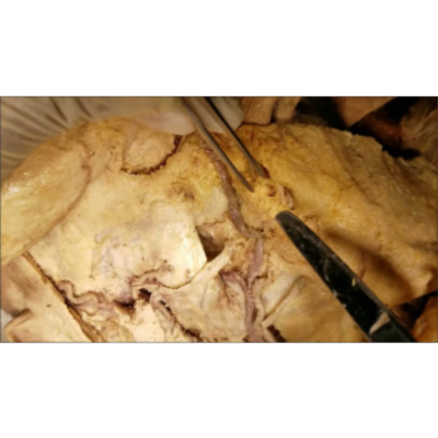 Facial Vessels Traced–Nosebleed–Danger Triangle–Cavernous Thrombosis–Horner Syndrome–Sanjoy Sanyal icon