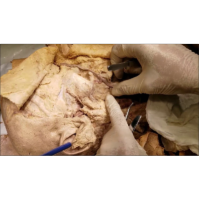 Facial Trigeminal Nerve Distribution of Face–Bells Palsy–Herpes Zoster Ophthalmicus – Sanjoy Sanyal