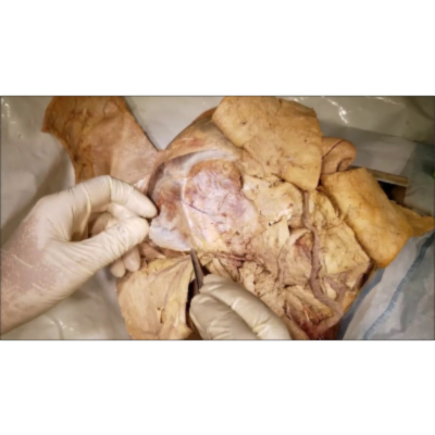 Temporal Fossa – 4 Fascial Layers - Boundaries - Contents - Surgical Procedures – Sanjoy Sanyal icon