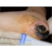 Pressure Ulcers & Pressure Ulcer Staging / Prevention icon